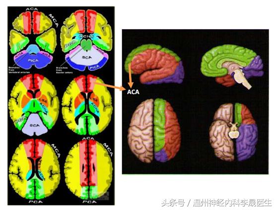 李医生讲中风，大脑前动脉堵塞的点点滴滴