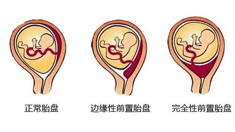 孕12周胎盘低置有宫腔积液怎么办,12周孕妇b超显示胎盘低置有危险吗