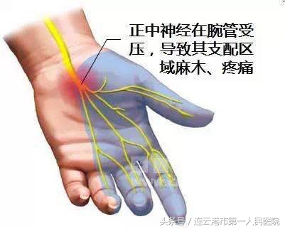 腕管综合征治疗特效药,腕管综合征做手术能彻底的好吗
