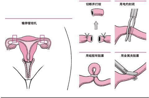 女的结扎扎哪里还可以怀孕吗,女人结扎的部位是关元穴吗