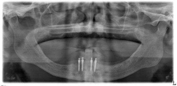 新加坡倍受老年人喜欢的迷你植牙，了解一下