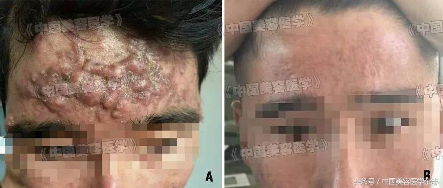 严重痤疮对人的心理的影响,严重痤疮会有哪些病症