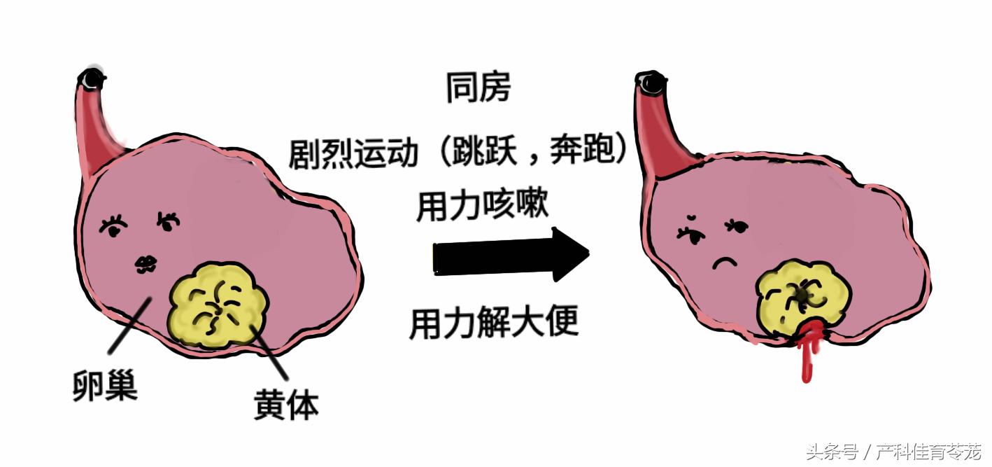 来大姨妈急腹症黄体破裂怎么办,妇科急腹症黄体破裂超声表现