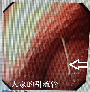 胸水抽了为什么还呼吸困难,胸水抽不出来了怎么回事