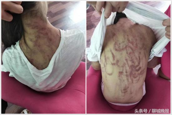 12岁女童被继母虐打,14岁女童遭继母虐打