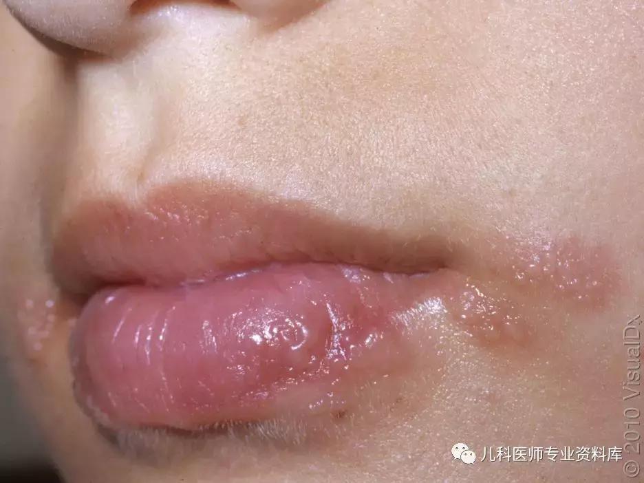 宝宝嘴巴上火的症状,宝宝嘴巴臭是积食还是上火