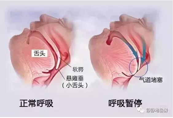 打呼噜怕影响别人不敢睡,打呼噜吸气有声呼气没声