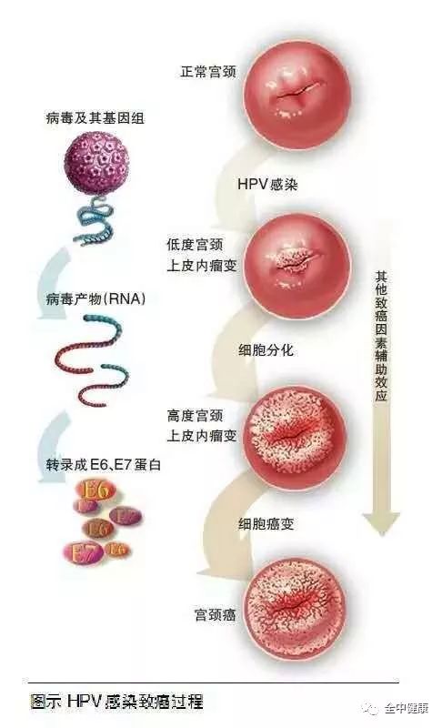 hpv感染到癌需要多久,hpv感染到宫颈癌都经历了哪些