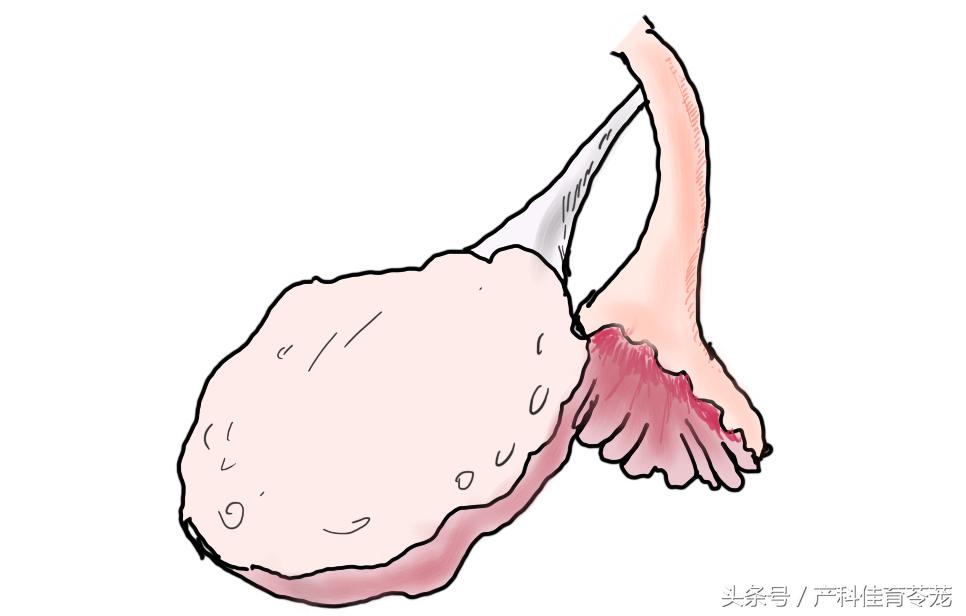 人流术后闭经，到底怎么了？