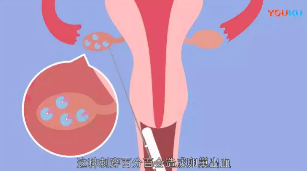 不打麻药取29颗卵子有多疼,不打麻药取29颗卵子
