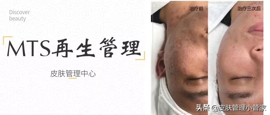 祛斑祛痘皮肤管理,皮肤管理祛痘有效吗