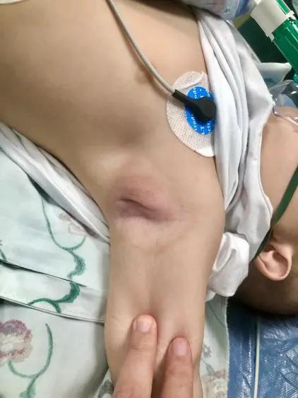 9个月宝宝发烧咳嗽半个月，腋下长了个“鹌鹑蛋”，医生说：这个病不简单