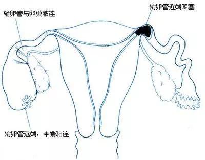 想要个宝宝，却遇上输卵管阻塞，该怎么办？
