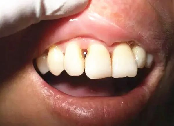 牙齿矫正中出现的黑三角会恢复吗,牙齿矫正后牙龈出现黑三角怎么办