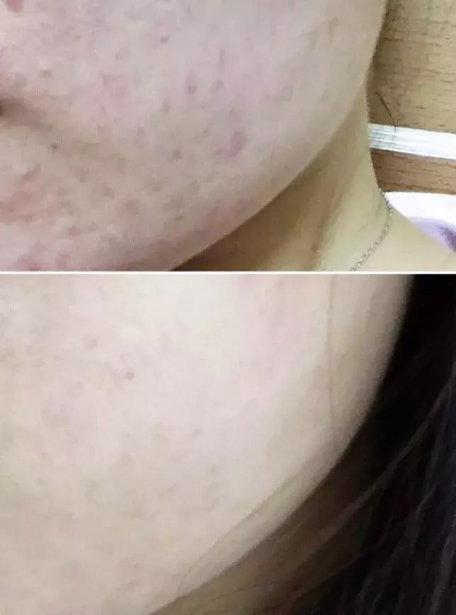 烟酰胺玻尿酸水光焕颜片美白效果,烟酰胺玻尿酸精华液美白淡斑霜