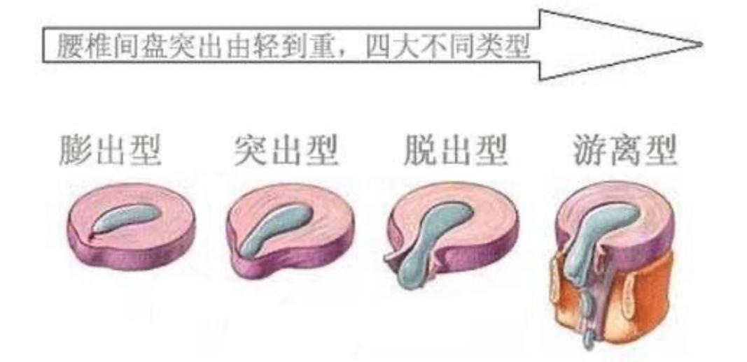 顽固性腰痛怎么治愈,困扰多年的腰疼问题终于搞清楚了