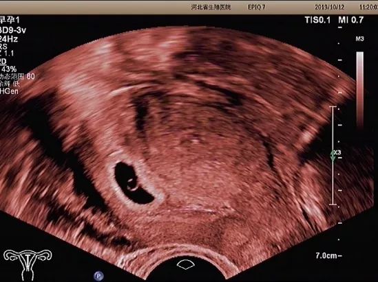 经阴道超声会不会伤害宝宝？看看专家怎么说