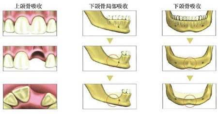 牙槽骨吸收严重怎么办？为什么会出现牙槽骨吸收？