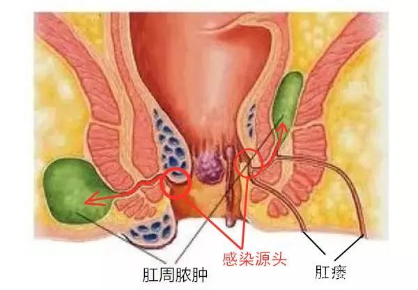 “菊花”不适，不一定都是“痔疮”的锅