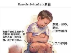 血液科史淑荣讲过敏性紫癜视频,史淑荣治血小板减少紫癜