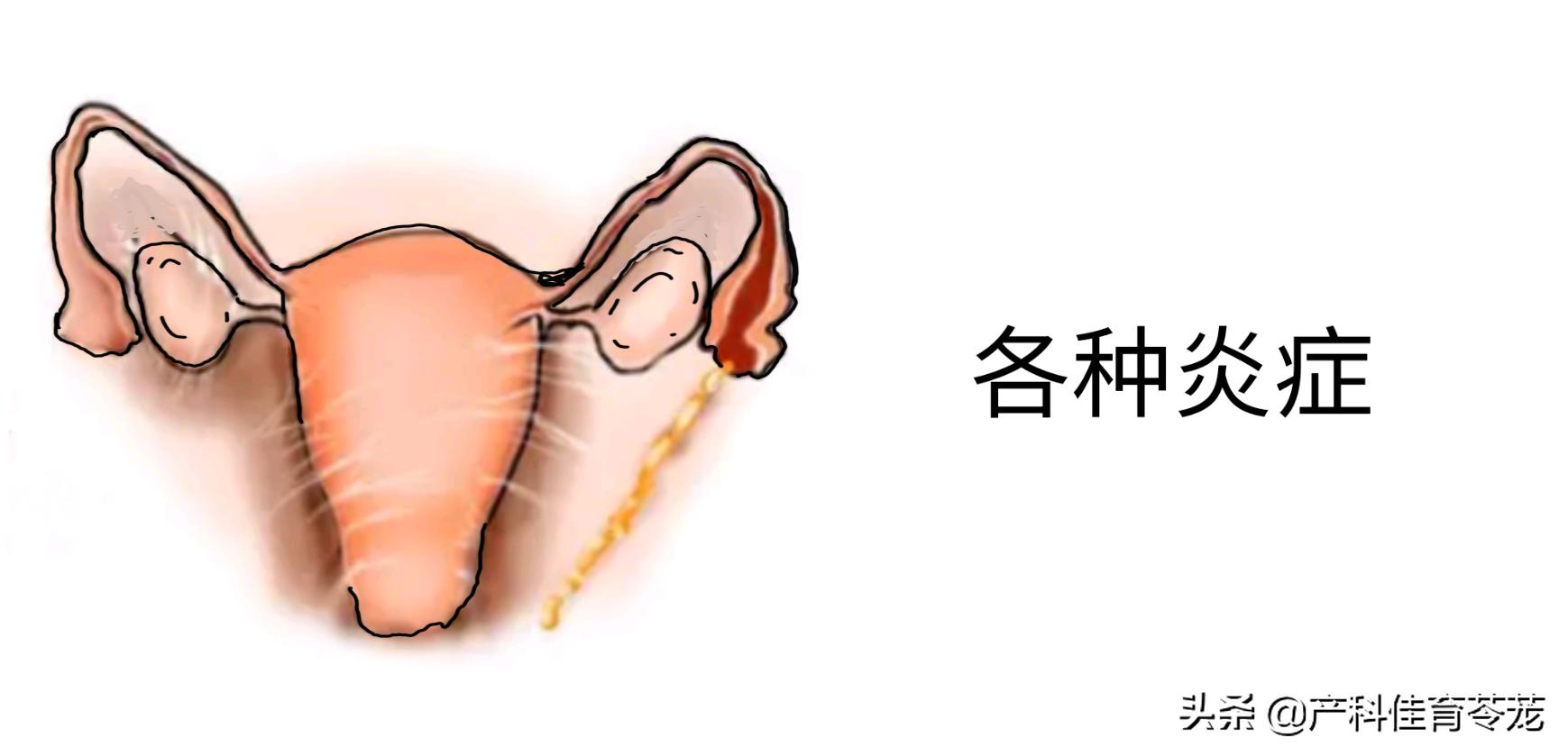 ca125正常到一个月急剧升高,ca125轻度升高与结直肠癌有关吗