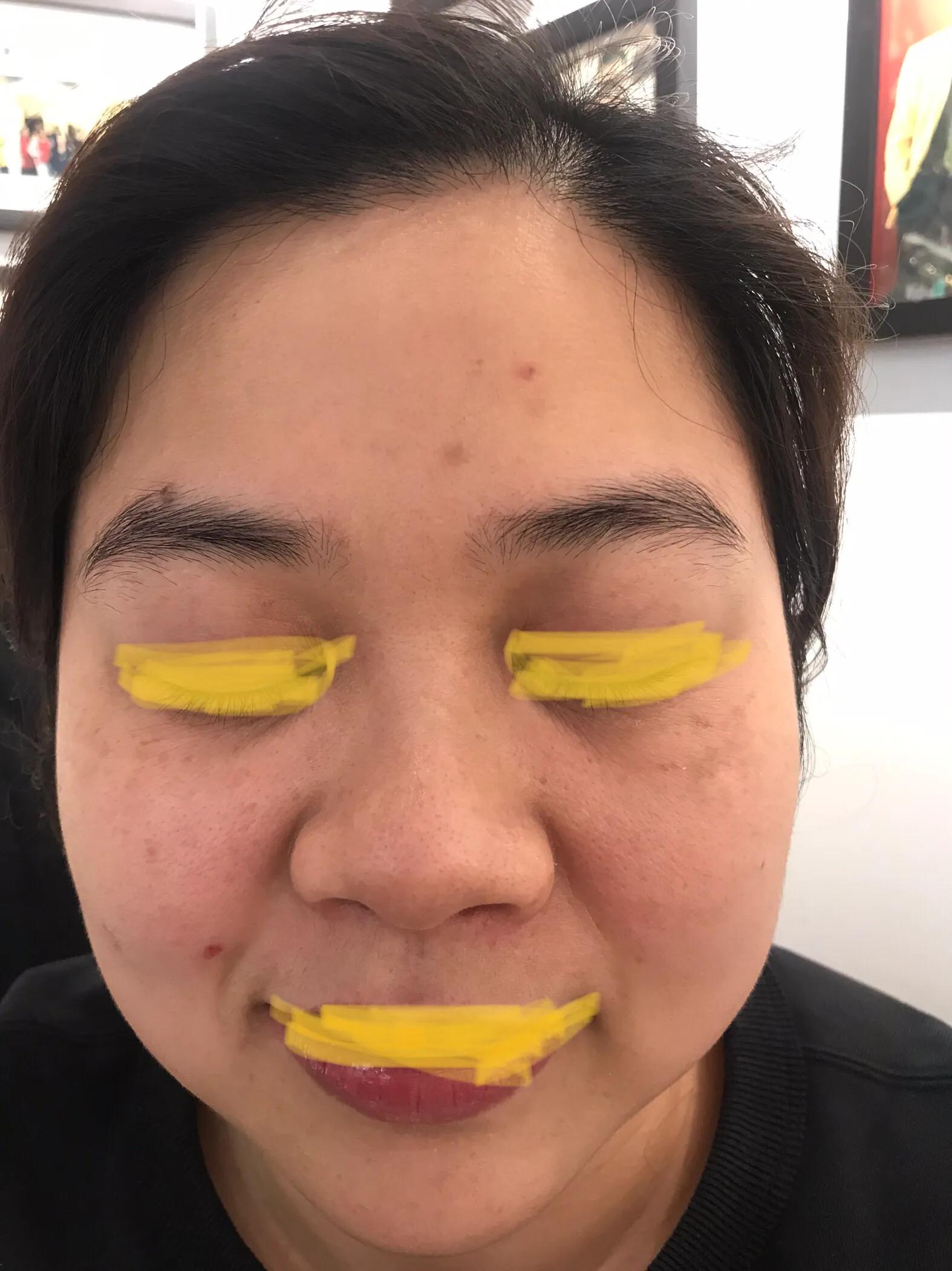 激光祛除斑点后留下的黑印,两次祛斑中间最好隔多久