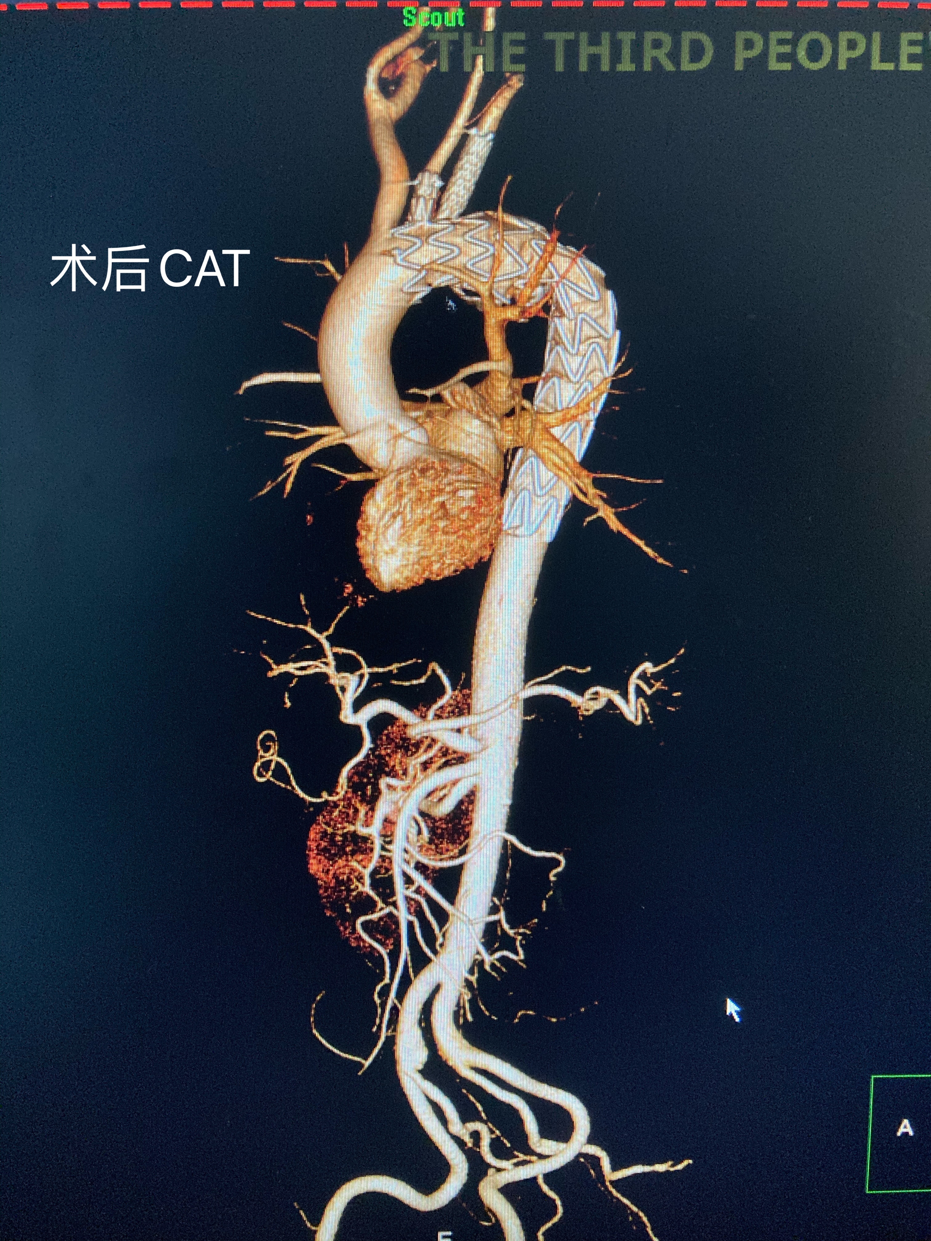 成都市第三人民医院一期工程,成都第三人民医院做心室支架