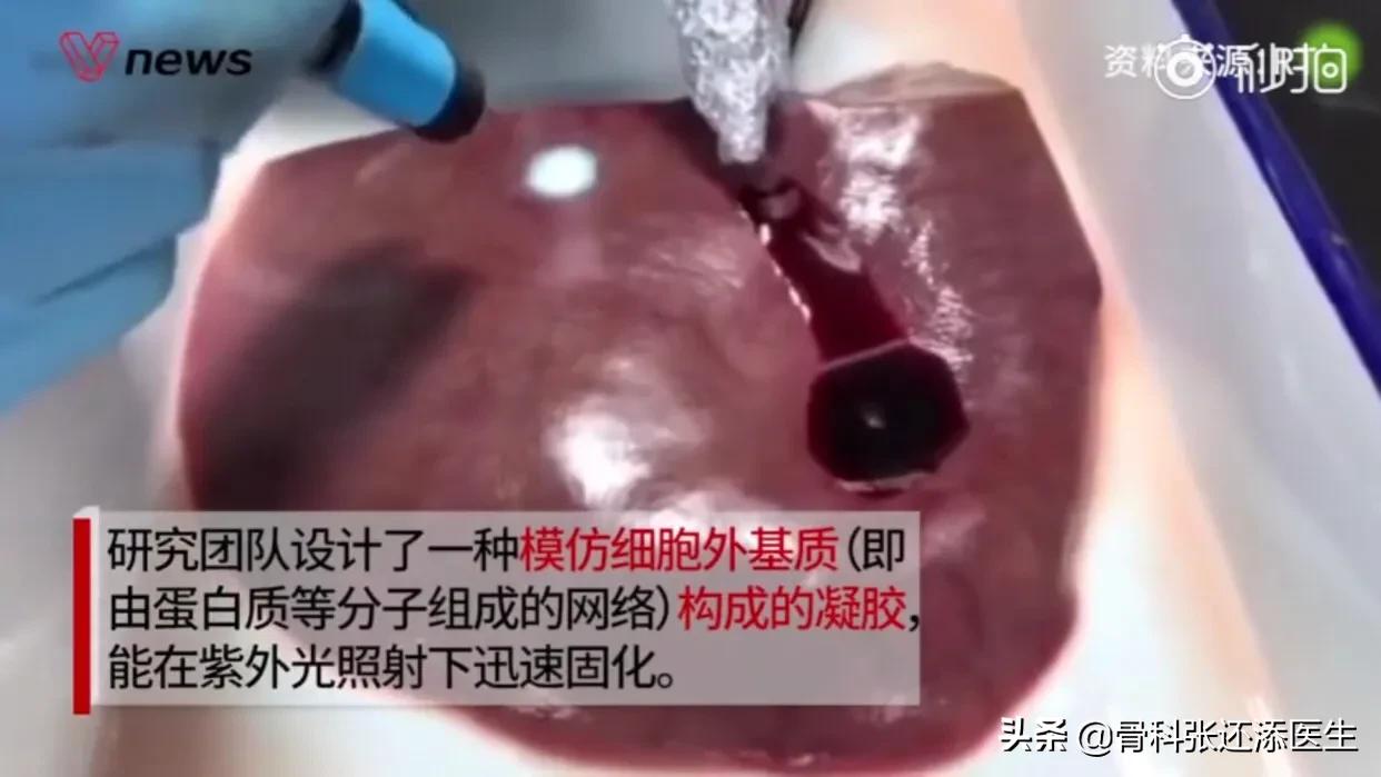 拉链缝合，可吸收止血海绵，这些医疗新科技，你有必要了解