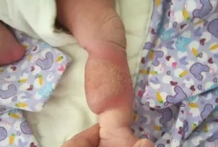 新生儿红胎记与血管瘤区别,红胎记血管瘤的最佳消除方法