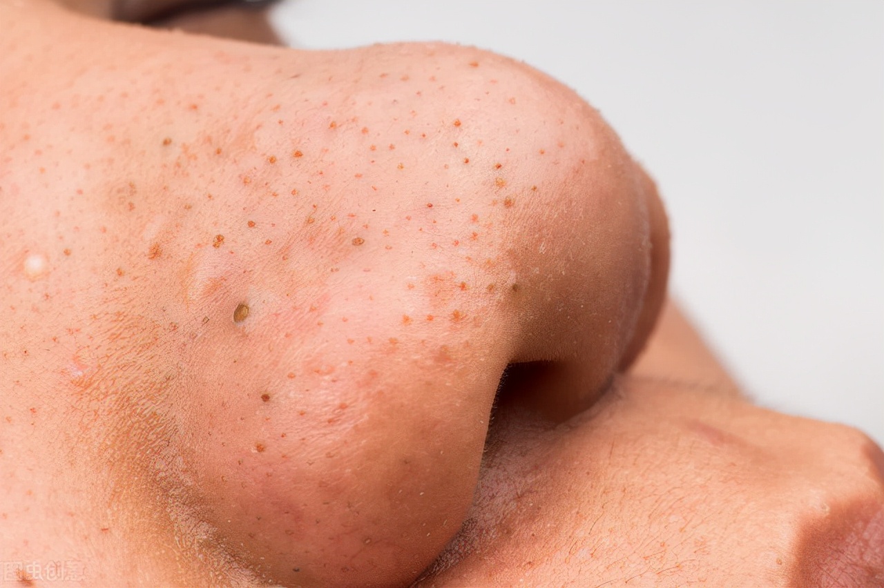 怎样去黑头最简单最有效,怎么去黑头好用又有效