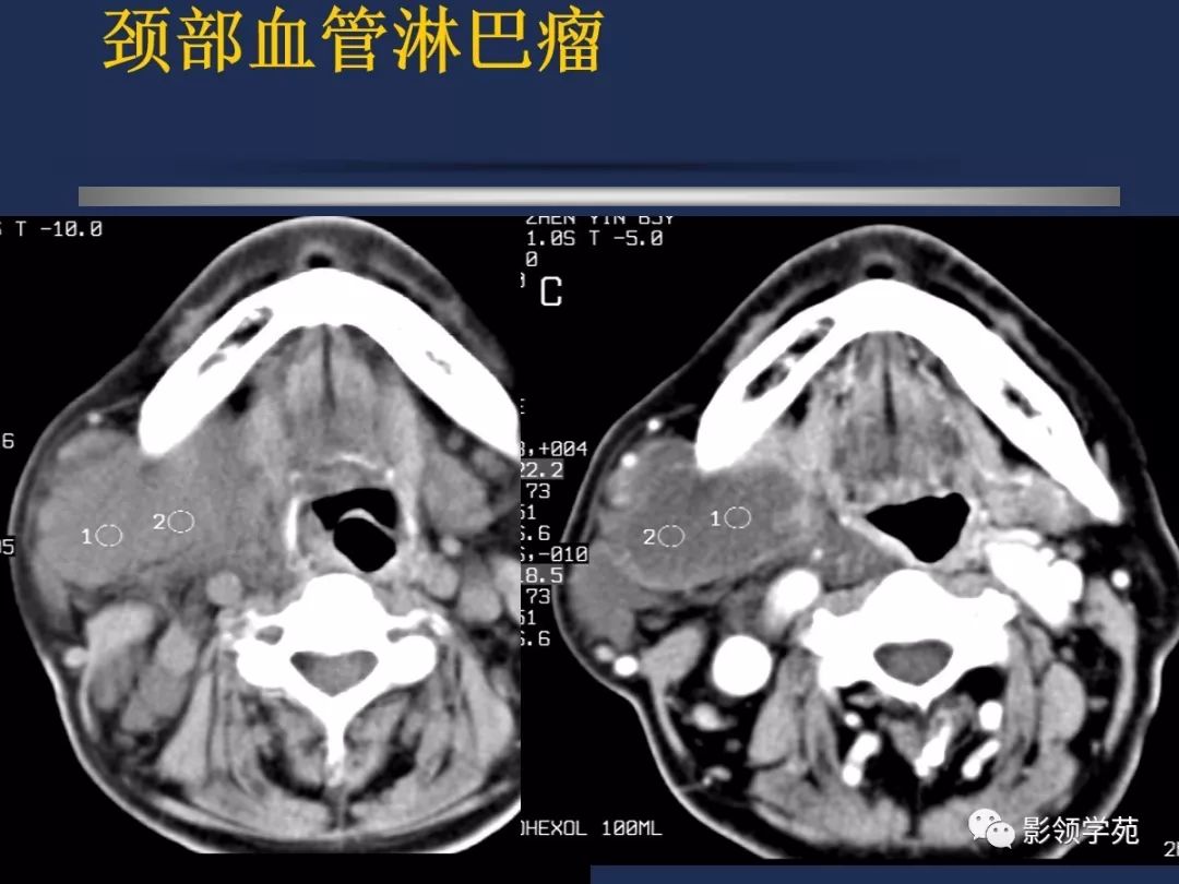 腮腺疾病影像学诊断,腮腺肿块影像诊断