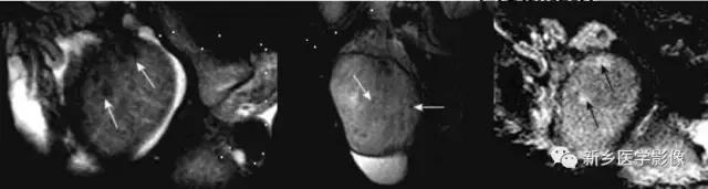 睾丸内部病变,睾丸病变mri