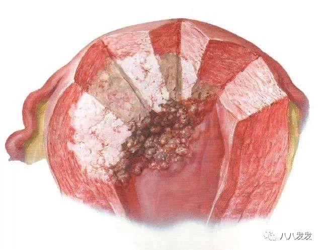 绝经期经血突然多,绝经后还来月经吃什么药