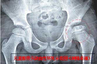 小孩髋关节脱臼复位手法视频,宝宝髋关节脱位可以正骨复位吗