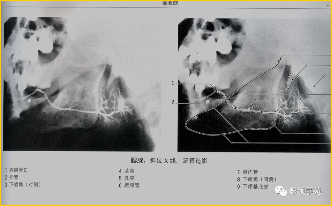 腮腺疾病影像学诊断,腮腺肿块影像诊断