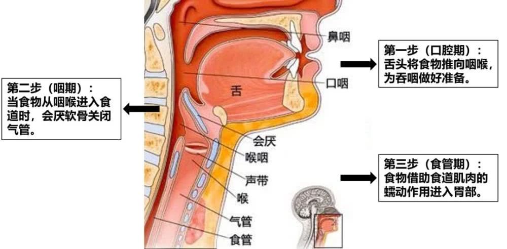 被口水呛到是脑梗前兆,脑梗引起的咽口水呛咳该怎样治疗