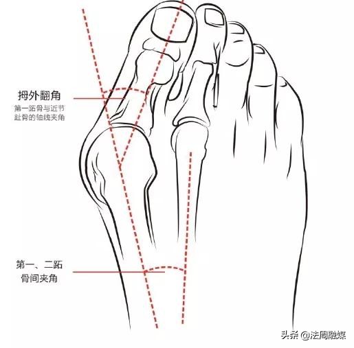 拇指长歪了？别慌！常德市第一中医医院专家帮您改“邪”归正