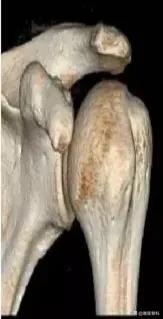 习惯性脱臼患者,习惯性脱臼一动就掉