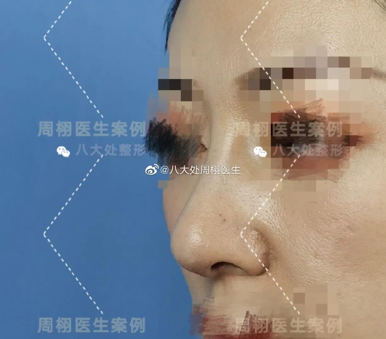 鼻整形手术,鼻整形术