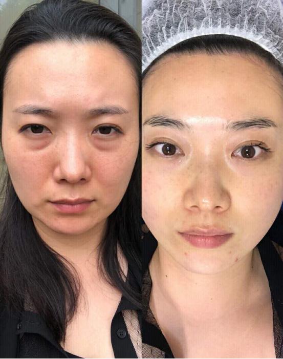 热玛吉术后注意事项和护理,做完热玛吉怎么护理效果最好