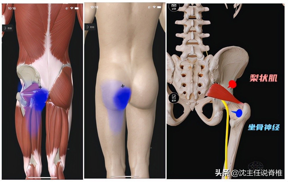 腰突引起的臀部麻腿疼哪个严重,怎样解决腰突带来的臀腿胀痛