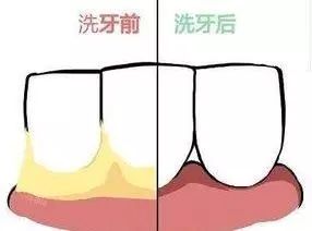 牙医眼中的洗牙竟然这么神奇，可以“包治口腔百病”