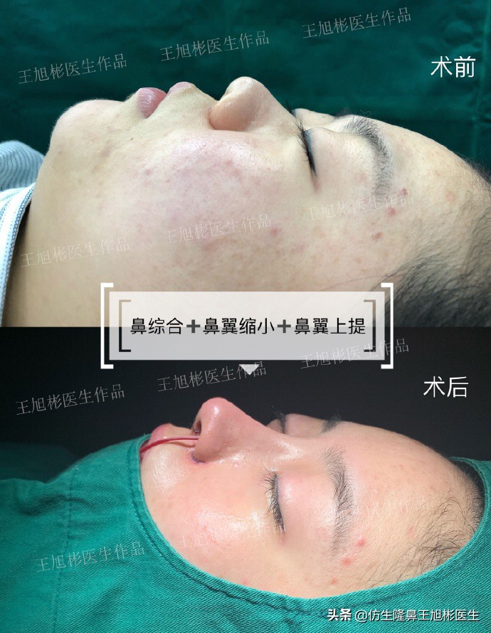 隆鼻鼻头大是失败了吗,大鼻头隆鼻手术案例