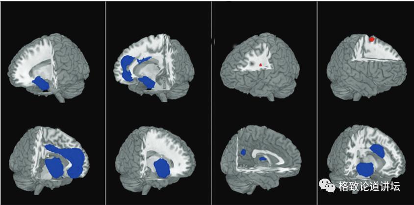 躁郁症心情转折原因,躁郁症的五大征兆和四大对策