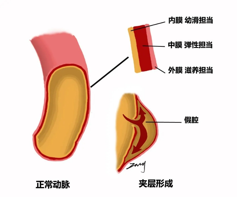 胸主动脉夹层是什么病有什么症状,主动脉瘤和主动脉夹层有什么症状