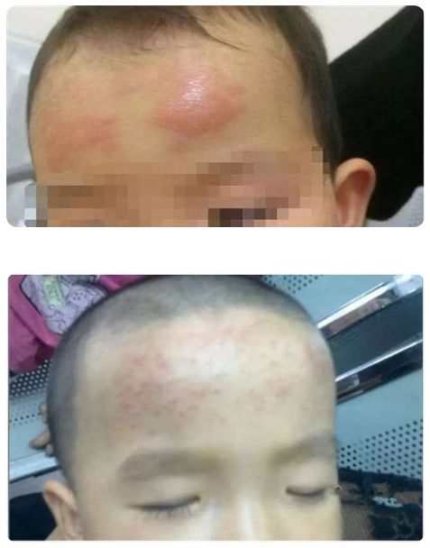 退热贴对发烧真的有用吗,发烧退热贴真的有用吗