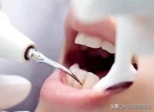 牙结石要怎么处理,自己在家处理牙结石