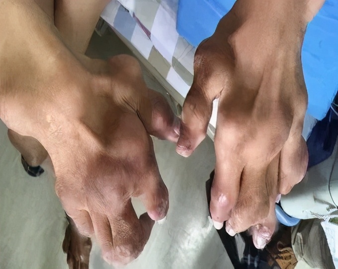 痛风治成尿毒症,尿毒症关节痛痛风