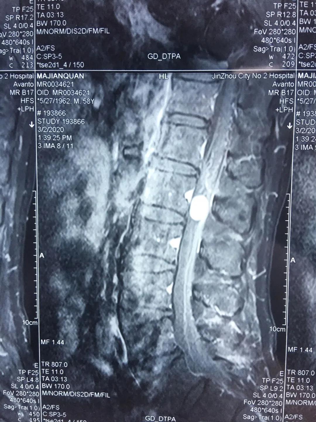 「不“瘤”余地」锦州市第二医院成功治疗椎管内肿瘤