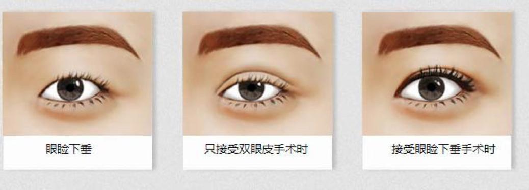 双眼皮手术详细教程,埋线双眼皮手术全过程